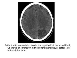 Patient with acute vision loss in the right half of the visual field ,
CT shows an infarction in the contralateral visual cortex , i.e
left occipital lobe
 
