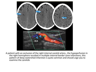 A patient with an occlusion of the right internal carotid artery , the hypoperfusion in
the right hemisphere resulted in multiple internal border zone infarctions, this
pattern of deep watershed infarction is quite common and should urge you to
examine the carotids
 