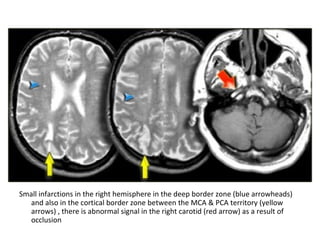 Small infarctions in the right hemisphere in the deep border zone (blue arrowheads)
and also in the cortical border zone between the MCA & PCA territory (yellow
arrows) , there is abnormal signal in the right carotid (red arrow) as a result of
occlusion
 