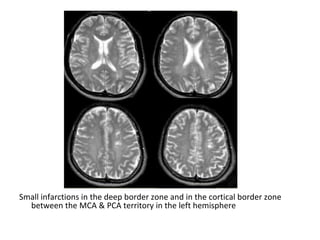 Small infarctions in the deep border zone and in the cortical border zone
between the MCA & PCA territory in the left hemisphere
 