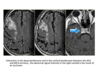 Infarctions in the deep borderzone and in the cortical borderzone between the ACA
and MCA territory , the abnormal signal intensity in the right carotid is the result of
an occlusion
 