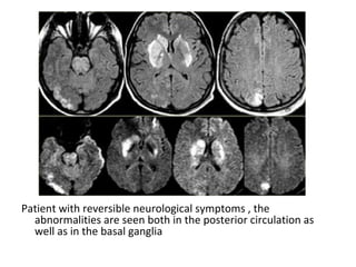 Patient with reversible neurological symptoms , the
abnormalities are seen both in the posterior circulation as
well as in the basal ganglia
 