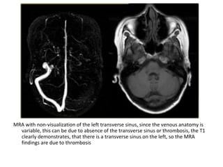 MRA with non-visualization of the left transverse sinus, since the venous anatomy is
variable, this can be due to absence of the transverse sinus or thrombosis, the T1
clearly demonstrates, that there is a transverse sinus on the left, so the MRA
findings are due to thrombosis
 