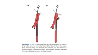 Comprehensive Overview of Acute Arterial Occlusive Disease and Limb ...