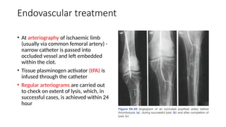 Comprehensive Overview of Acute Arterial Occlusive Disease and Limb ...