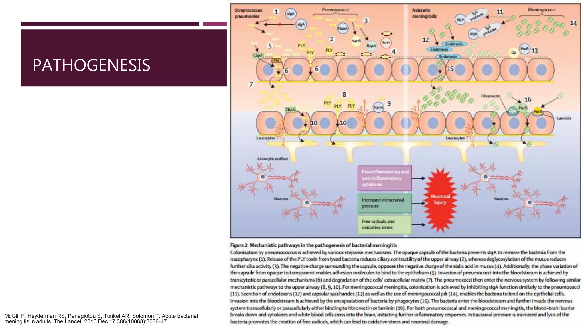 Acute Bacterial Meningitis in Adults | PPT