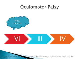 VI III IV
Most
common
Kremmyda O, Frenzel C, Hüfner K, Goldschagg N, Brem C, Linn J, Strupp M. Acute binocular diplopia: peripheral or central?. Journal of neurology. 2020
Dec;267(1):136-42.
 