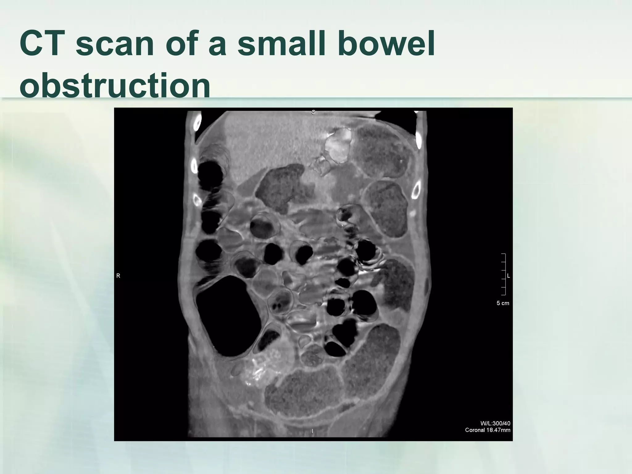 CT scan of a small bowel
obstruction
 