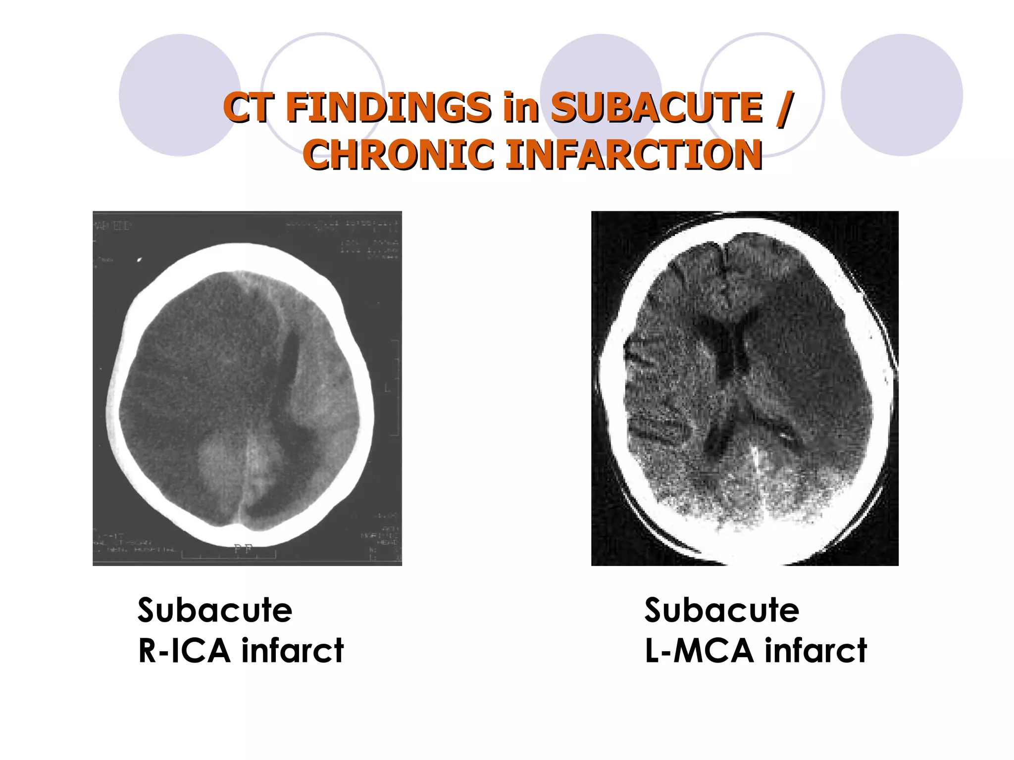 Acute brain attack 911 | PPT