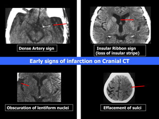 Acute brain attack 911 | PPT
