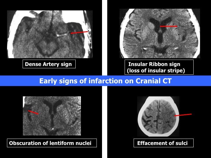 Acute brain attack 911 Acute brain attack 911