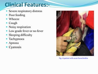 Acute bronchiolitis | PPTX