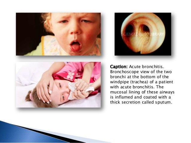 Acute bronchitis in children