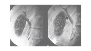 Acute calculosis cholecystitis in general medicine | PDF