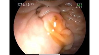 Acute calculosis cholecystitis in general medicine | PDF