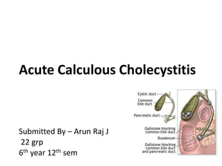 Acute Calculous Cholecystitis
Submitted By – Arun Raj J
22 grp
6th year 12th sem
 