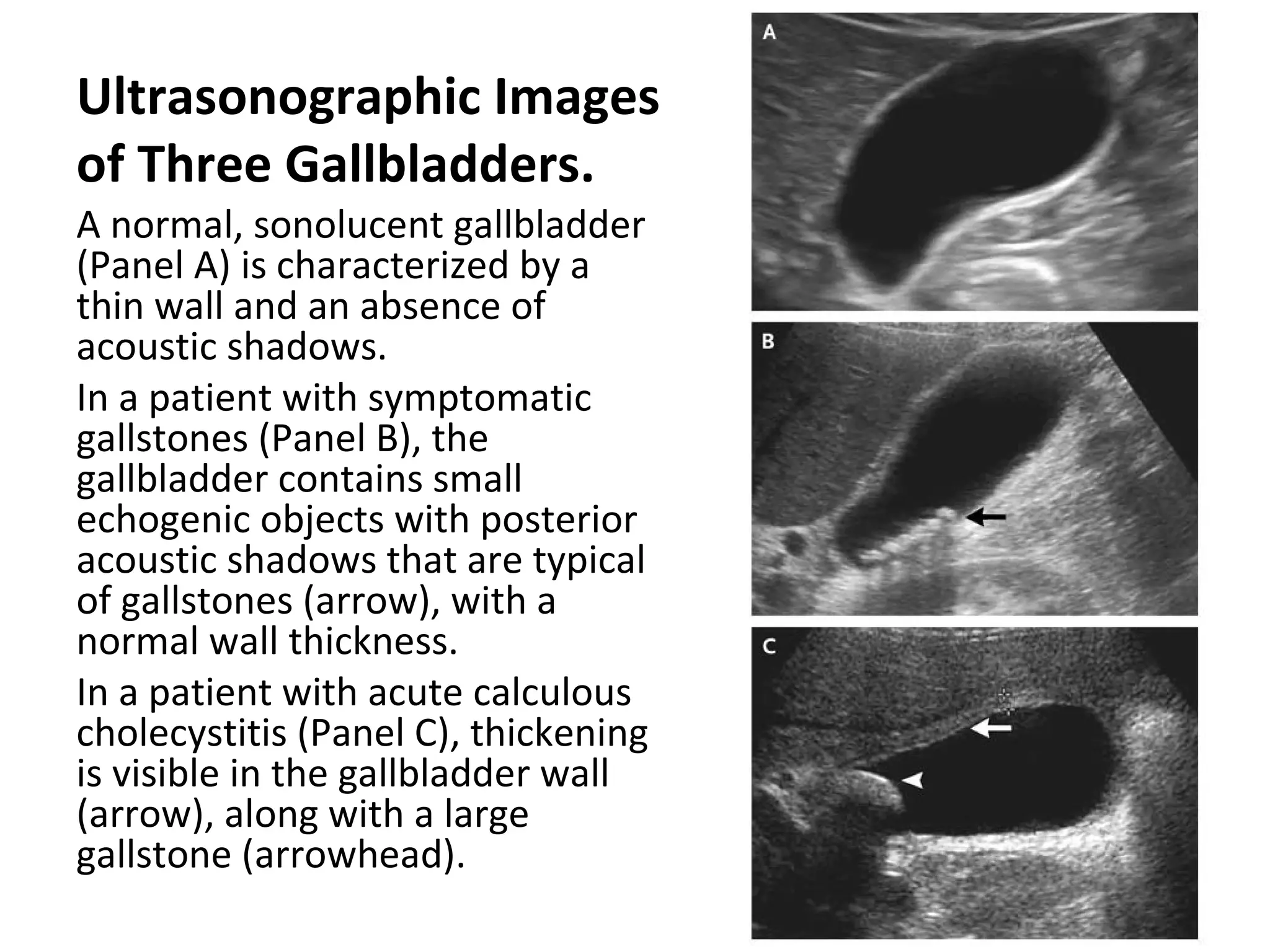 Ultrasonographic Images
of Three Gallbladders.
A normal, sonolucent gallbladder
(Panel A) is characterized by a
thin wall and an absence of
acoustic shadows.
In a patient with symptomatic
gallstones (Panel B), the
gallbladder contains small
echogenic objects with posterior
acoustic shadows that are typical
of gallstones (arrow), with a
normal wall thickness.
In a patient with acute calculous
cholecystitis (Panel C), thickening
is visible in the gallbladder wall
(arrow), along with a large
gallstone (arrowhead).
 