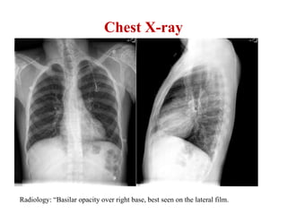 Sickle cell disease Acute Chest Syndrome.pptx