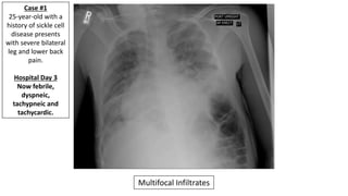 Multifocal Infiltrates Acute Chest Syndrome - EMGuidewire's Radiology Reading Room | PPTX