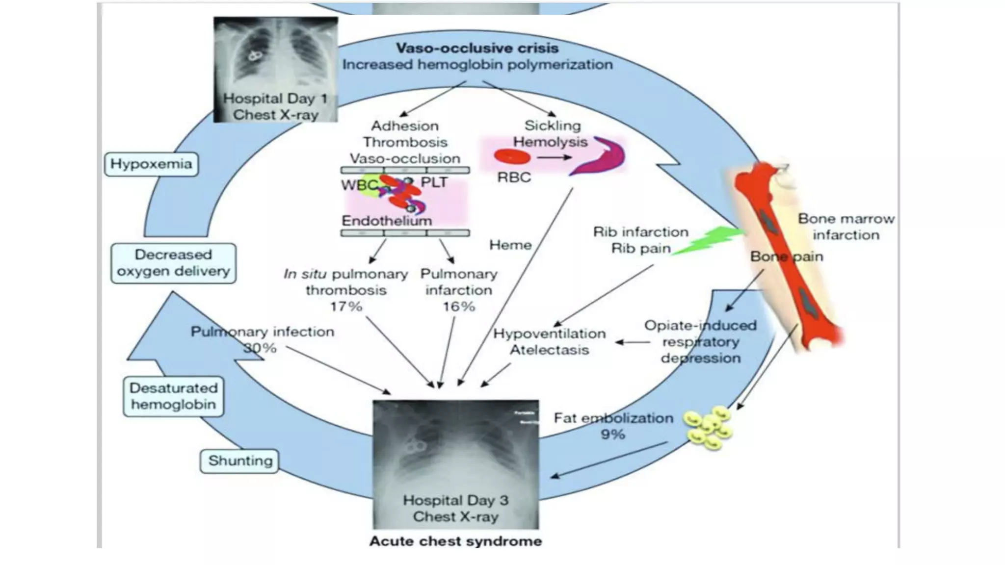 Acute Chest Syndrome (ACS) in Sickle Cell Disease. | PPT