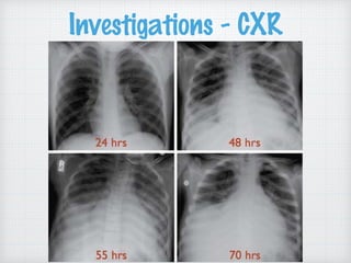 Investigations - CXR
 