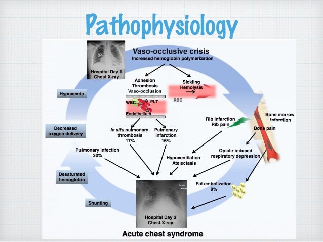acute chest syndrome sickle cell pneumonia treatment chart