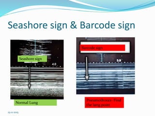 Acute chest trauma PPT By Dr Anil Kumar, Assistant Professor ,AIIMS ...