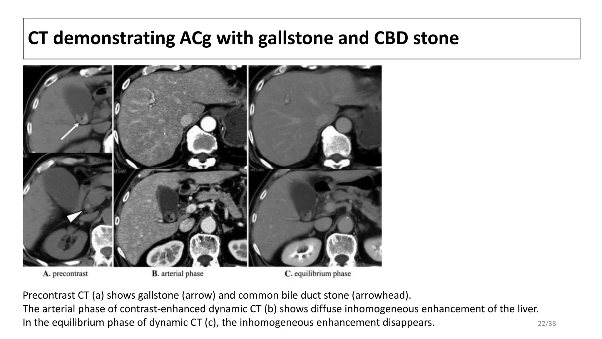 CT demonstrating ACg with gallstone and CBD stone
Precontrast CT (a) shows gallstone (arrow) and common bile duct stone (arrowhead).
The arterial phase of contrast-enhanced dynamic CT (b) shows diffuse inhomogeneous enhancement of the liver.
In the equilibrium phase of dynamic CT (c), the inhomogeneous enhancement disappears. 22/38
 