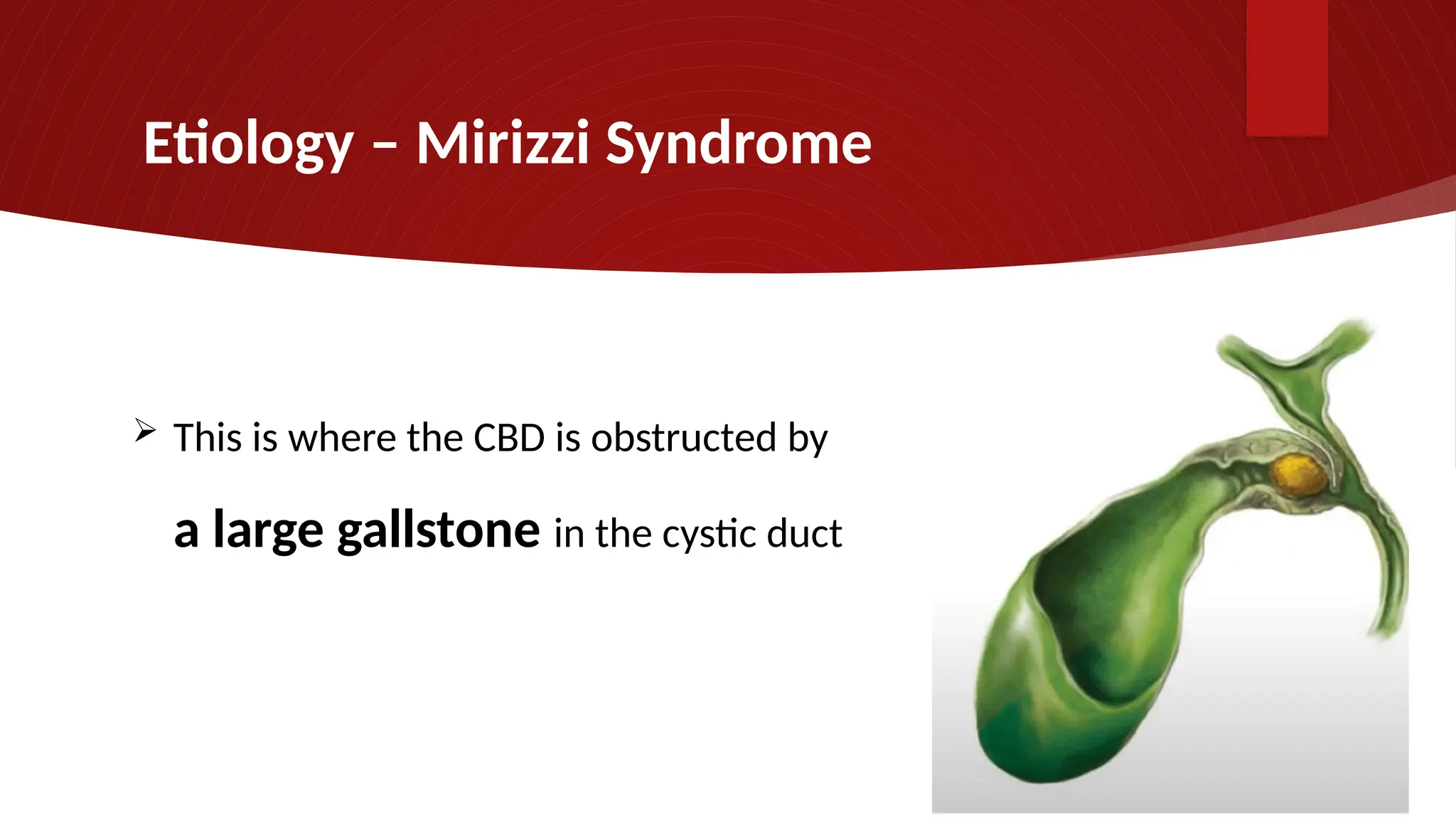 Etiology – Mirizzi Syndrome
 This is where the CBD is obstructed by
a large gallstone in the cystic duct
 