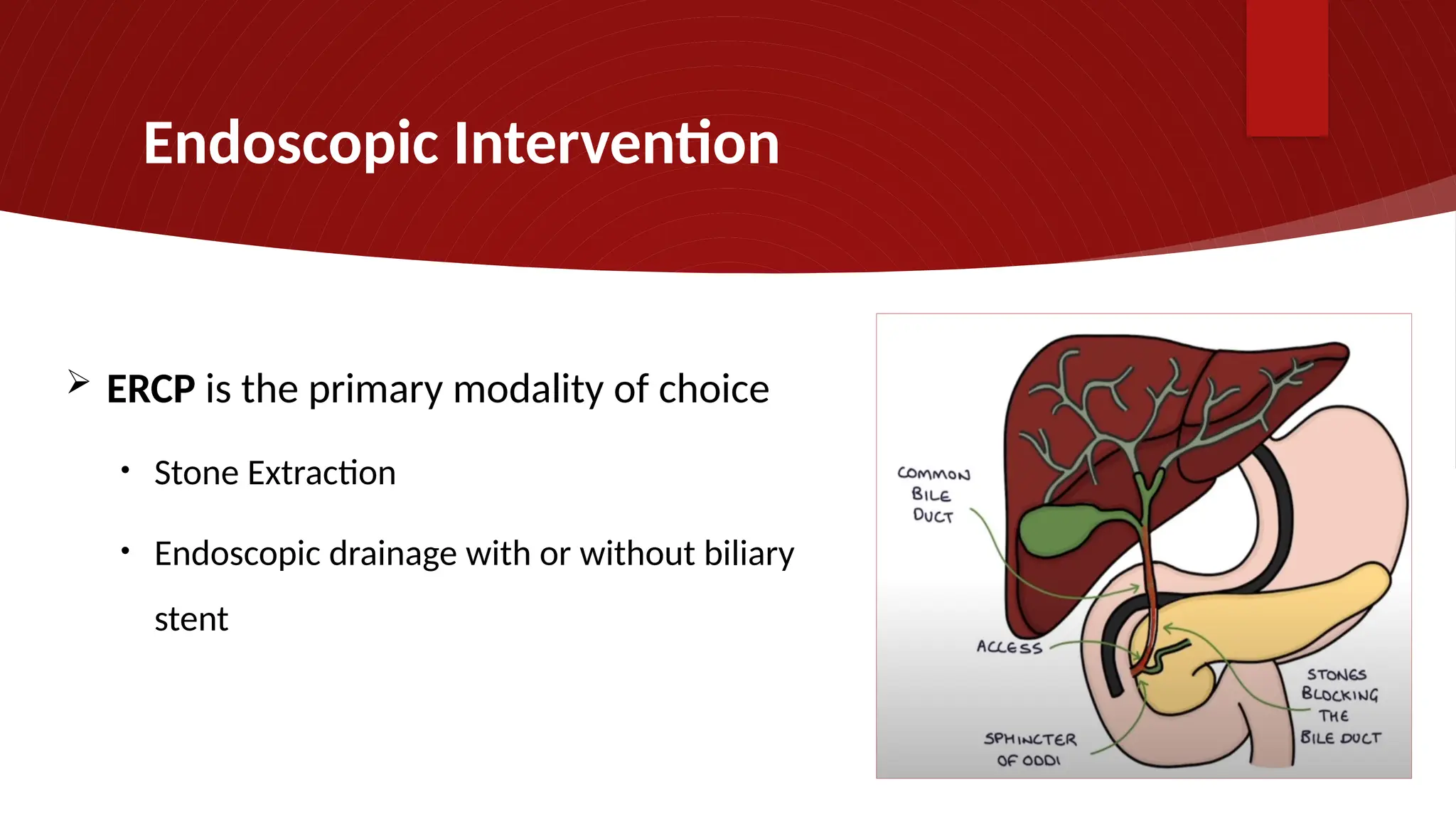 Endoscopic Intervention
 ERCP is the primary modality of choice
• Stone Extraction
• Endoscopic drainage with or without biliary
stent
 