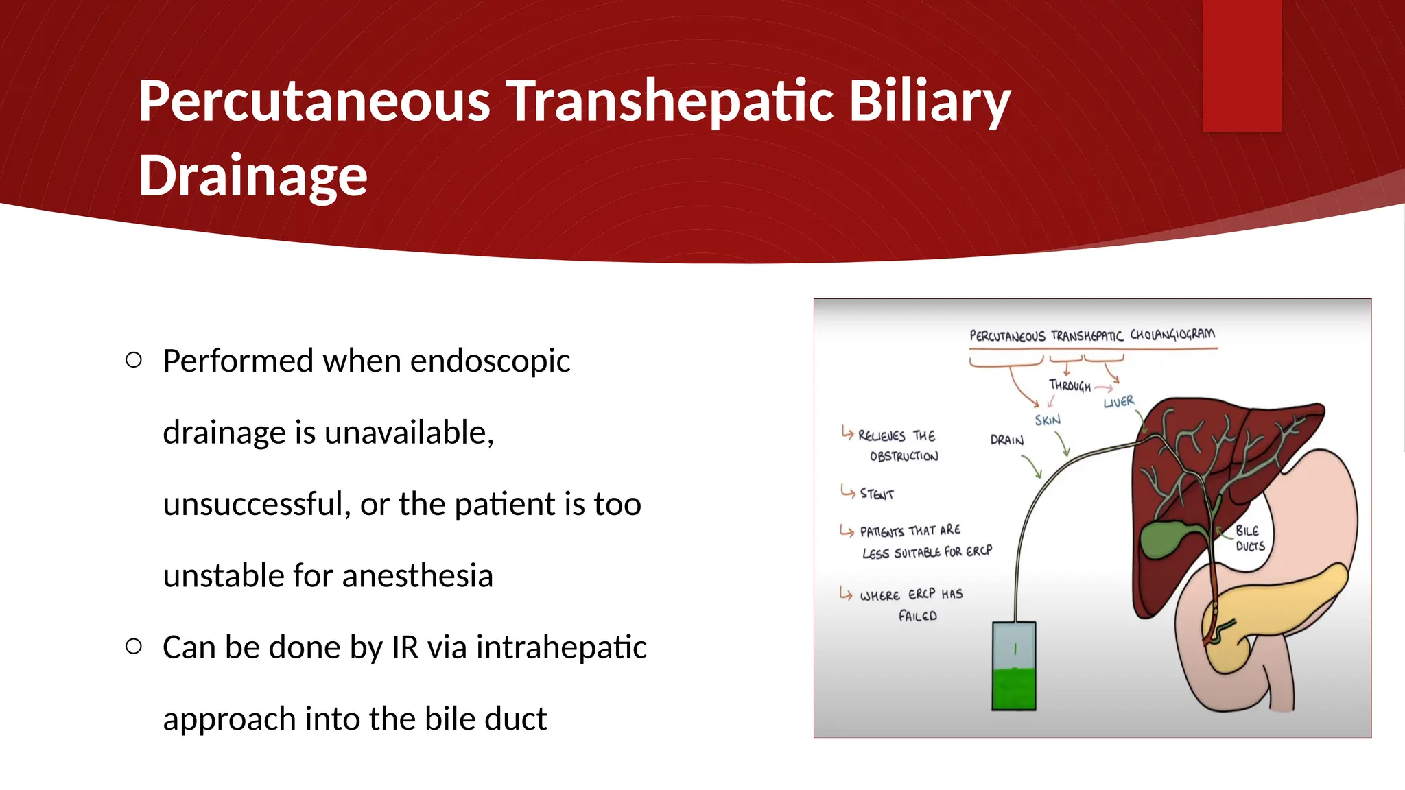Percutaneous Transhepatic Biliary
Drainage
o Performed when endoscopic
drainage is unavailable,
unsuccessful, or the patient is too
unstable for anesthesia
o Can be done by IR via intrahepatic
approach into the bile duct
 
