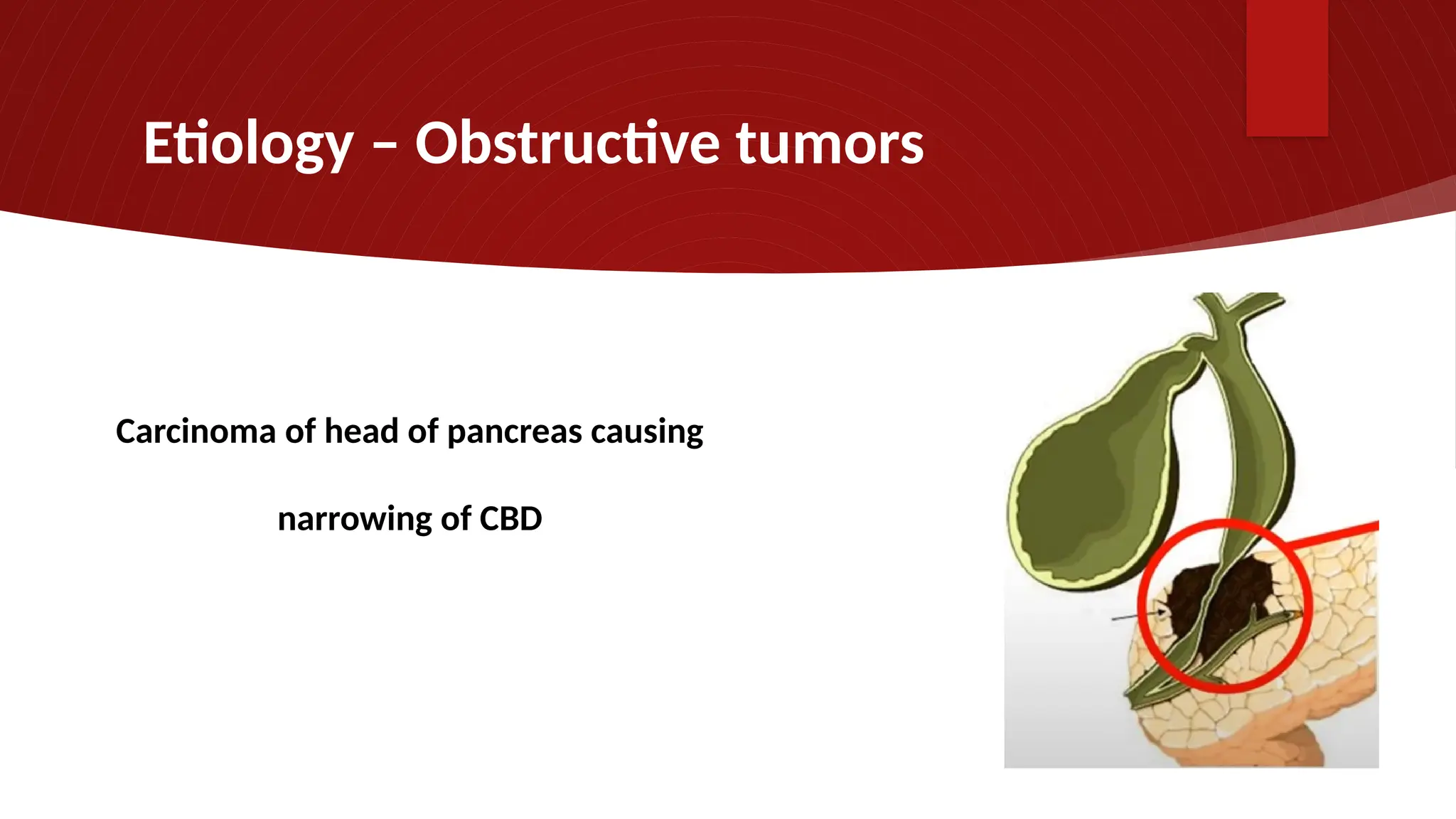 Etiology – Obstructive tumors
Carcinoma of head of pancreas causing
narrowing of CBD
 