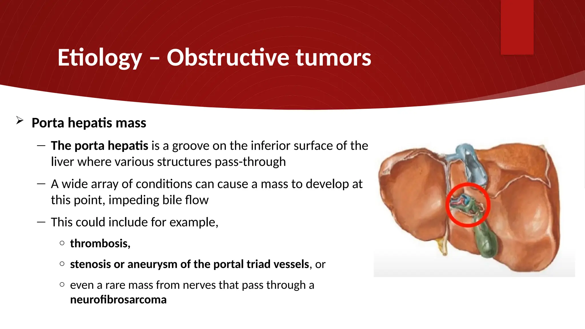 Etiology – Obstructive tumors
 Porta hepatis mass
― The porta hepatis is a groove on the inferior surface of the
liver where various structures pass-through
― A wide array of conditions can cause a mass to develop at
this point, impeding bile flow
― This could include for example,
o thrombosis,
o stenosis or aneurysm of the portal triad vessels, or
o even a rare mass from nerves that pass through a
neurofibrosarcoma
 