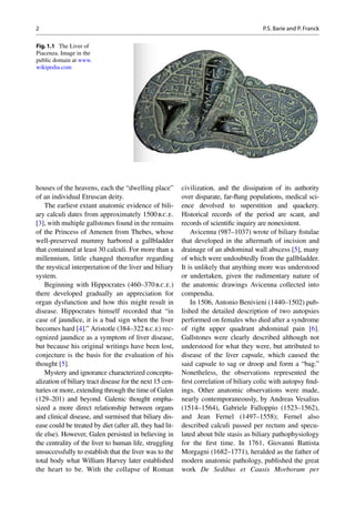 Acute cholecystitis | PDF