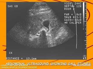 ABDOMINAL ULTRASOUND SHOWING GALL DILIP S.RAJPAL
CONSULTANT GEN. SURGEON            DR
                                       STONES
LAPROSCOPIST & COLOPROCTOLOGIST
 
