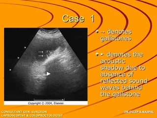 Case 1
                                       → denotes
                                       gallstones

                  →
                  →                    ► denotes the
                                       acoustic
                                       shadow due to
                      ►                absence of
                                       reflected sound
                                       waves behind
                                       the gallstone

CONSULTANT GEN. SURGEON                       DR DILIP S.RAJPAL
LAPROSCOPIST & COLOPROCTOLOGIST
 