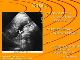 Case 3
                                           Curved arrow
                                           – Two small stones
                                             at GB neck
                             ◄
                                           Straight arrow
                                           – Thickened GB wall


                                           ◄
                                           – pericholecystic fluid
                                             = dark lining
                                             outside the wall
CONSULTANT GEN. SURGEON                              DR DILIP S.RAJPAL
LAPROSCOPIST & COLOPROCTOLOGIST
 