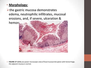 • Morphology:
the gastric mucosa demonstrates
  edema, neutrophilic infiltrates, mucosal
  erosions, and, if severe, ulceration &
  hemorrhage.




 FIGURE 17–13 B.Low-power microscopic view of focal mucosal disruption with hemorrhage;
  the adjacent mucosa is normal.
 
