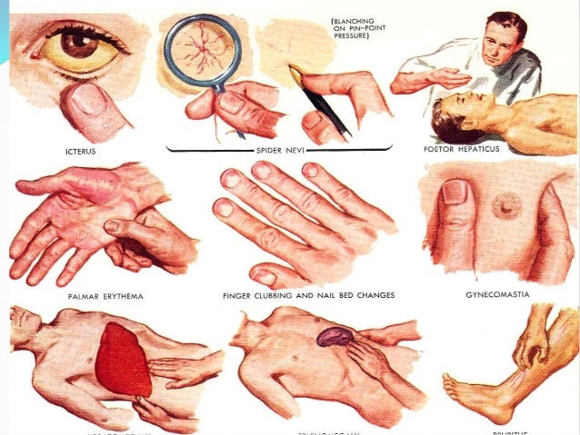Acute & chronic liver failure
