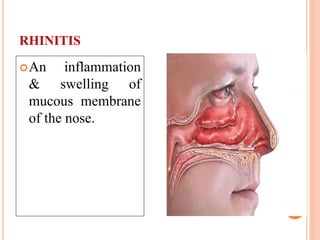 ACUTE & CHRONIC RHINITIS.pptx