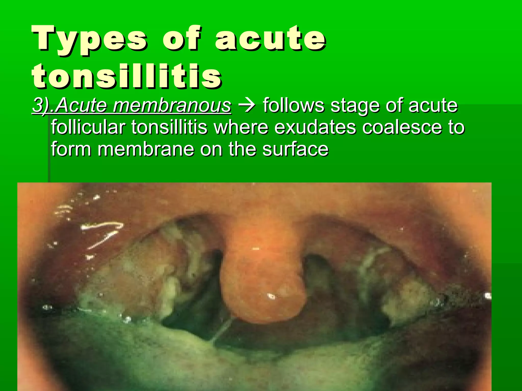 Acute Chronic Tonsillitis And Their Management PPT Acute Chronic Tonsillitis And Their Management PPT