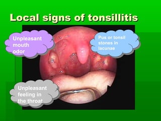Local signs of tonsillitisLocal signs of tonsillitis
Unpleasant
mouth
odor
Unpleasant
mouth
odor
Unpleasant
feeling in
the throat
Unpleasant
feeling in
the throat
Pus or tonsil
stones in
lacunae
Pus or tonsil
stones in
lacunae
 