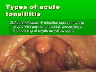 Types of acuteTypes of acute
tonsillitistonsillitis
2).Acute follicular2).Acute follicular  infection spread into theinfection spread into the
crypts with purulent material, presenting atcrypts with purulent material, presenting at
the opening of crypts as yellow spots.the opening of crypts as yellow spots.
 