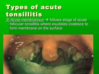 Types of acuteTypes of acute
tonsillitistonsillitis
3).Acute membranous3).Acute membranous  follows stage of acutefollows stage of acute
follicular tonsillitis where exudates coalesce tofollicular tonsillitis where exudates coalesce to
form membrane on the surfaceform membrane on the surface
 