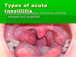 Types of acuteTypes of acute
tonsillitistonsillitis4).Acute parenchymatous4).Acute parenchymatous  tonsil is uniformlytonsil is uniformly
enlarged and congestedenlarged and congested
 