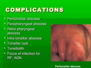 COMPLICATIONSCOMPLICATIONS
 Peritonsillar abscessPeritonsillar abscess
 Parapharyngeal abscessParapharyngeal abscess
 Retro pharyngealRetro pharyngeal
abscessabscess
 Intra tonsillar abscessIntra tonsillar abscess
 Tonsillar cystTonsillar cyst
 TonsillolithTonsillolith
 Focus of infection forFocus of infection for
RF, AGNRF, AGN
Peritonsillar abscess
 