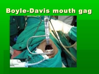 Boyle-Davis mouth gagBoyle-Davis mouth gag
 