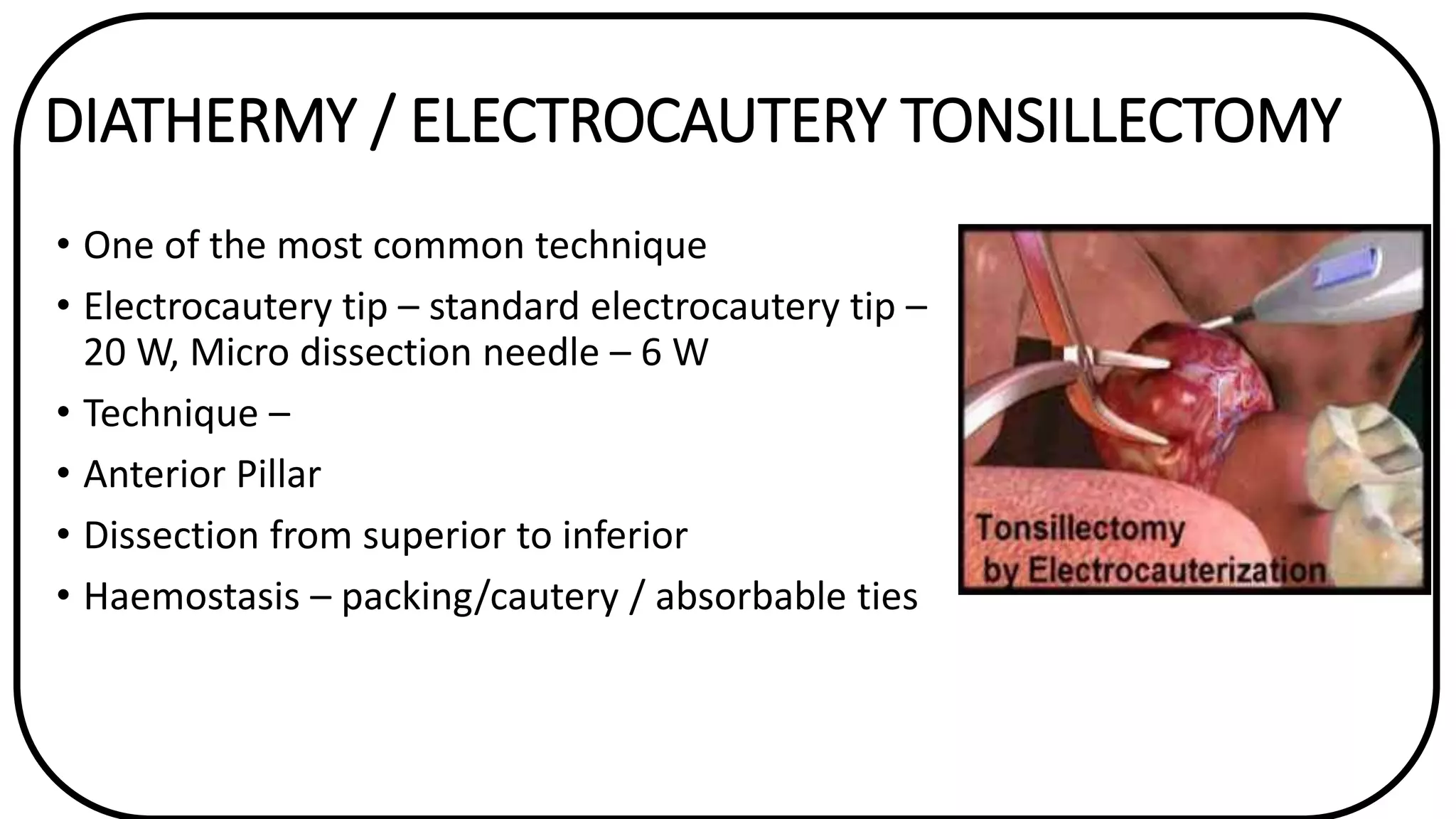 Electrodissection Acute and Chronic Tonsillitis | PPTX