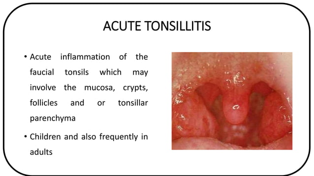 Acute and Chronic Tonsillitis | PPTX | Ear, Nose and Throat Conditions ...