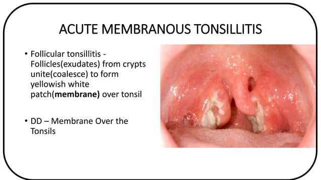 Acute and Chronic Tonsillitis | PPTX | Ear, Nose and Throat Conditions ...